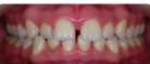 Apiñamiento dental Antes