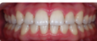 Apiñamiento dental Después