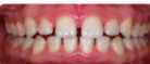 Dientes separados Antes