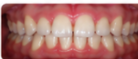 Dientes separados Después